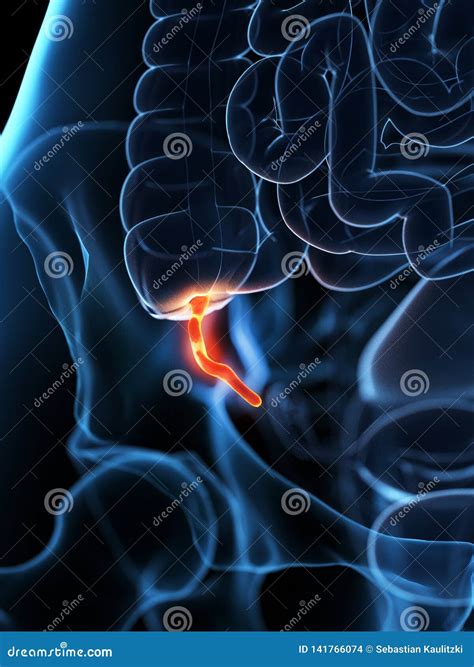 Appendicitis Inflamed Appendix Labeled Chart Cartoon Vector