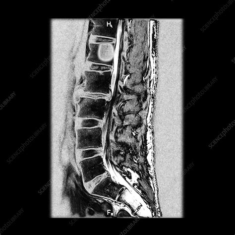 Mri Of Vertebral Body Hemangioma Stock Image C0047461 Science