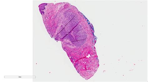 Mucocele Histology