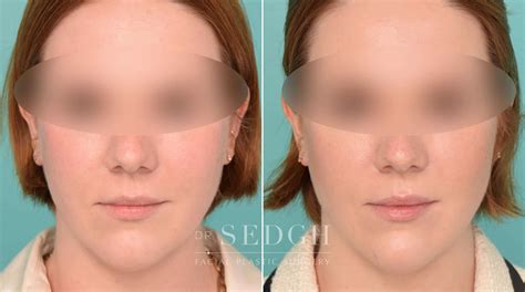 Chin Filler Before And After Photos Sedgh Plastic Surgery