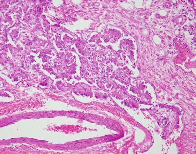 Soft Tissue Tumors of the Mediastinum | Basicmedical Key