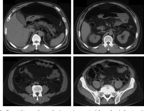 Figure 1 From Extended Retroperitoneal Necrotizing Fasciitis With Genital Involvement