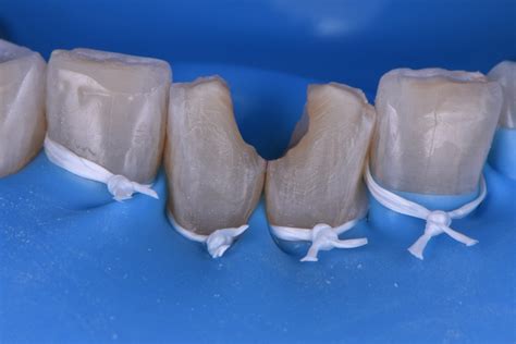 Large Volume Dental Replacements On Lower Incisors