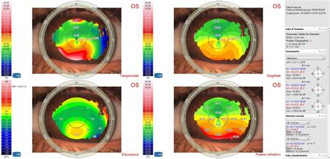 Topografia Corneale Ottica Maniscalco