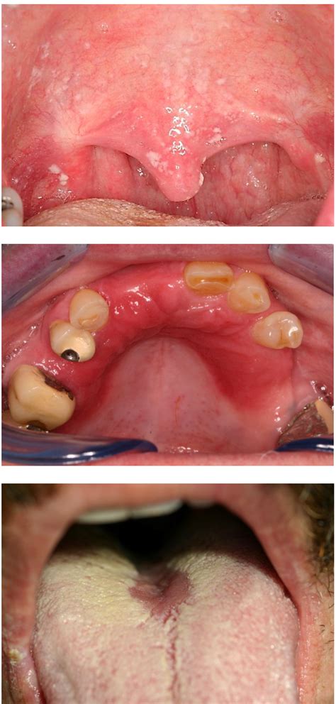 Benign Infectious Lesions Conditions Of The Oral Mucous Membrane