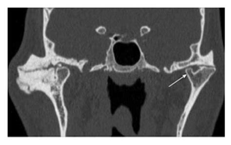 Imaging Of The Temporomandibular Joint An Update