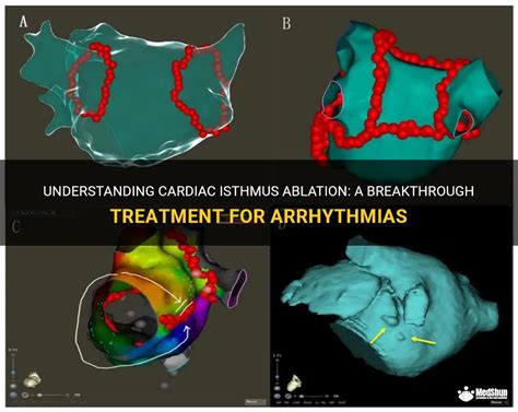 Understanding Cardiac Isthmus Ablation A Breakthrough Treatment For