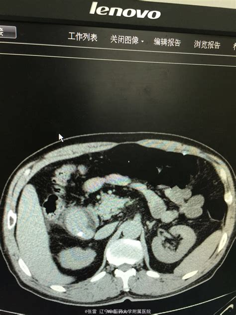 胆囊结石伴急性化脓性胆囊炎