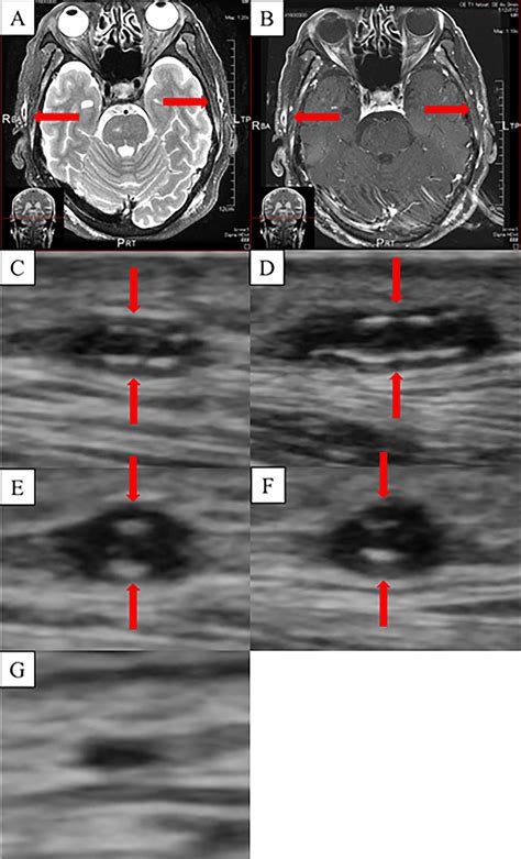 Figure Magnetic Resonance Imaging Of The Temporal Arteries A Fat