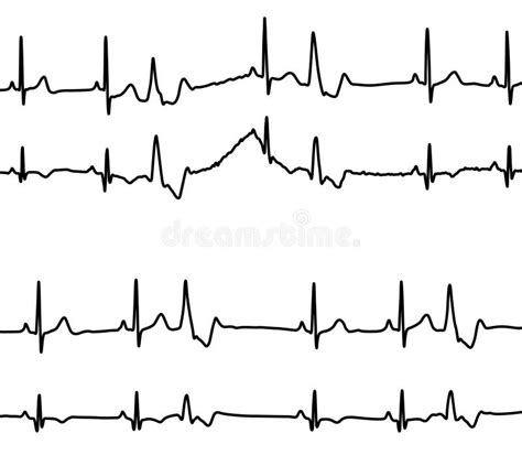 Modelo De Vf Fibrilaci N Ventricular De Demostraci N Del