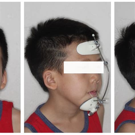 Pdf A Novel Approach Using Customized Miniplates As Skeletal