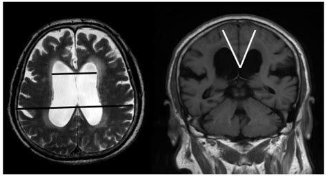 Severe Hydrocephalus Mri