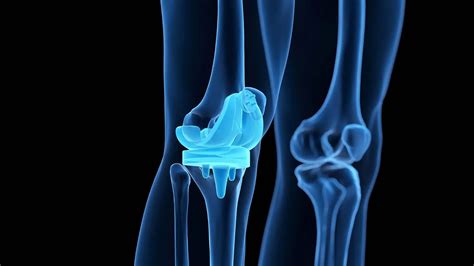 Knee Replacement Alternative For Wilmington NC Carolina Joint And