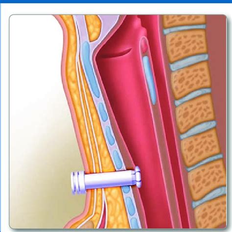 Pdf Restoring Speech To Tracheostomy Patients