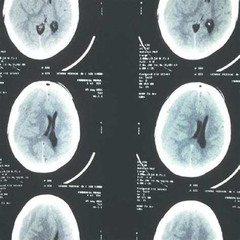 Computed Tomography Scan Of The Brain Showing A Right Chronic Subdural