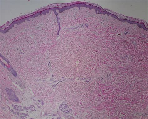 Mri Safety Update 2008 Part 1 Mri Contrast Agents And Nephrogenic Systemic Fibrosis Ajr