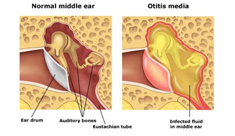 Speech Mama: The First Ear Infection