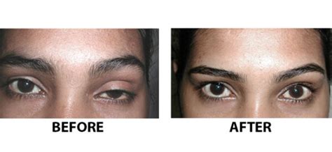 Hooded Eye Botox Eyebrow Lift Everything You Need To Know