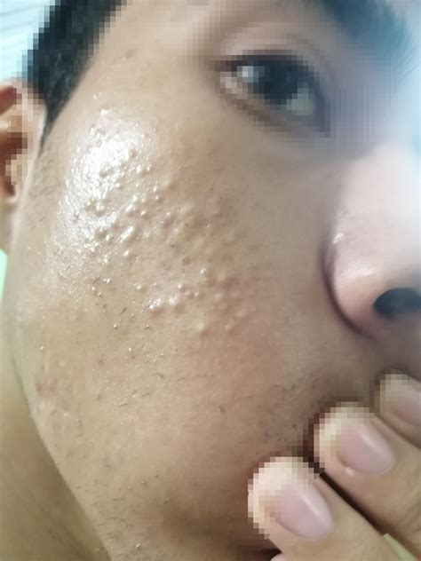 [acne] What Would Help With Texture And Closed Comedones R Skincareaddiction