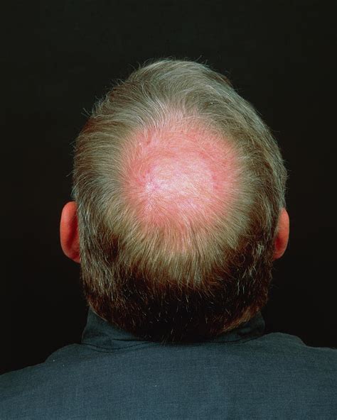 Baldness Photograph By Alex Bartel Science Photo Library Fine Art America