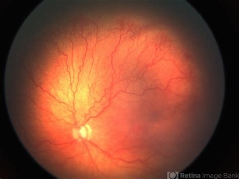 Retinopathy Of Prematurity ROP Diagnosis And Management