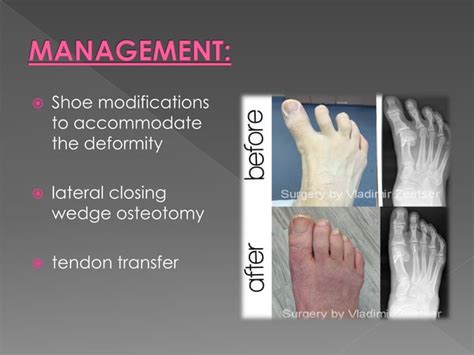 Foot Deformities | PPT