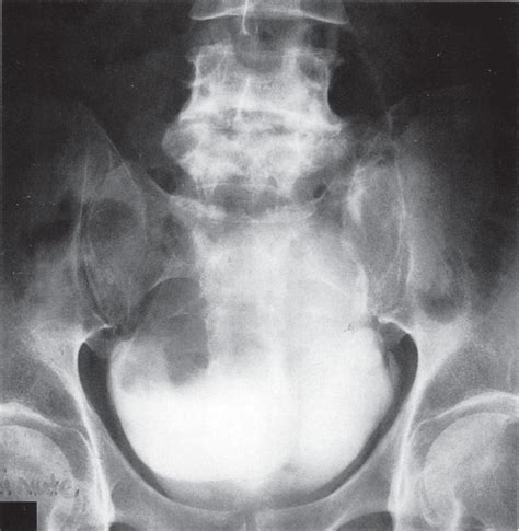 Squamous Cell Carcinoma Of The Urinary Bladder Annals Of Saudi Medicine