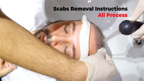 Hair Transplant Scabs Removal Instructions 2024 Youtube