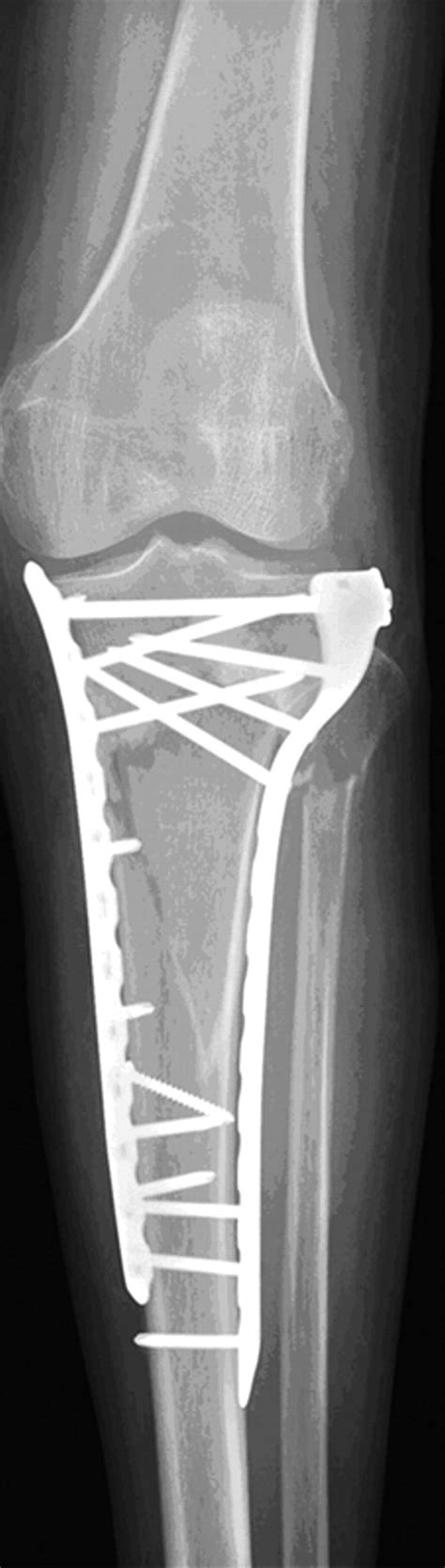 The Operative Management Of Osteoporotic Fractures Of The Knee Bone And Joint