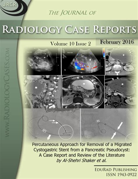 Percutaneous Approach for Removal of a Migrated Cystogastric Stent from ...