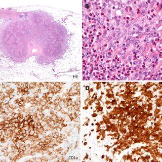 Histopathological Findings Obtained From A Nodule In Right Lower Field