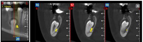 Cone Beam Computerized Tomography Of The Impacted Lower Right Second