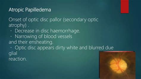 Papilledema | PPT