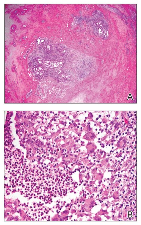 Idiopathic Granulomatous Mastitis | MDedge Dermatology