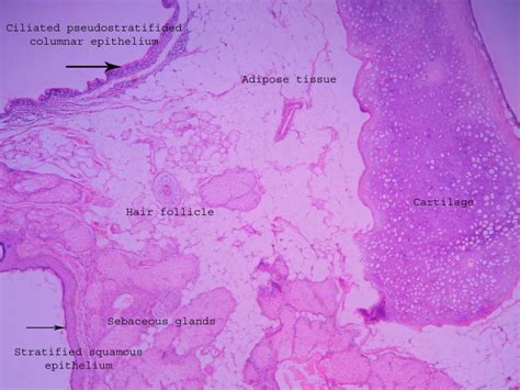 Dermoid Cyst Ovary Histopathology Guru