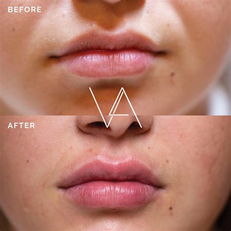 London Lip Fillers Lip Injections And Enhancement In London