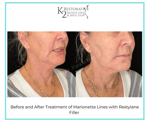 Before After Fillers Injectables At K2 Restorative Medicine