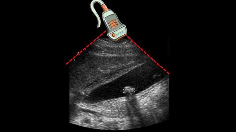 Ultrasound of Gallbladder & Gallstone - YouTube