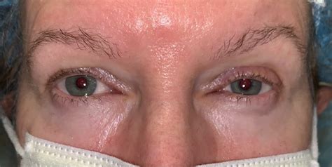 10 Upper Eyelid Surgery Before And After Photos Dallas Plano Texas Cosmetic Reconstructive