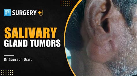 Salivary Gland Tumors By Dr Saurabh Dixit Prepladder Neet Ss Youtube