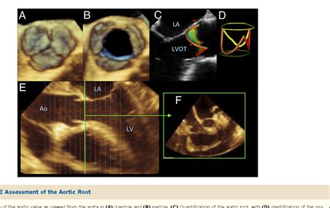 Figure From Quantification Of Mitral Valve Anatomy By 59 Off