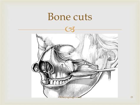 Maxillectomy a review