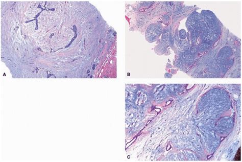 Fibroepithelial Neoplasms Basicmedical Key