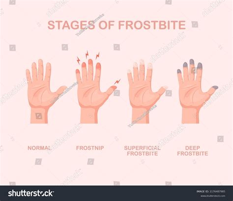 Frozen Hands Fingers Stage Frostbite Skin Stock Vector (Royalty Free ...