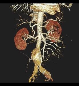 CP Advanced Imaging | CT Angiogram