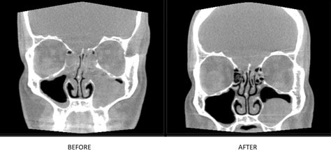 Ct Scan Progress Surgery Advice Chronic Sinusitis R Sinusitis