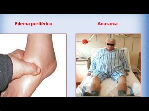 Case Presentation Of Anasarca Medicine Youtube