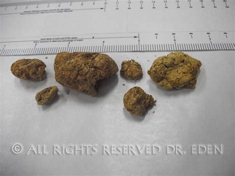 Gallstone Pictures Gallery See Images Of Real Gallstones Passed