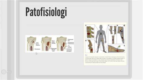 Osteomielitis Youtube