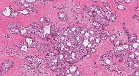 Intraductal Carcinoma Of The Salivary Glands Ottawa Atlas Of Pathology